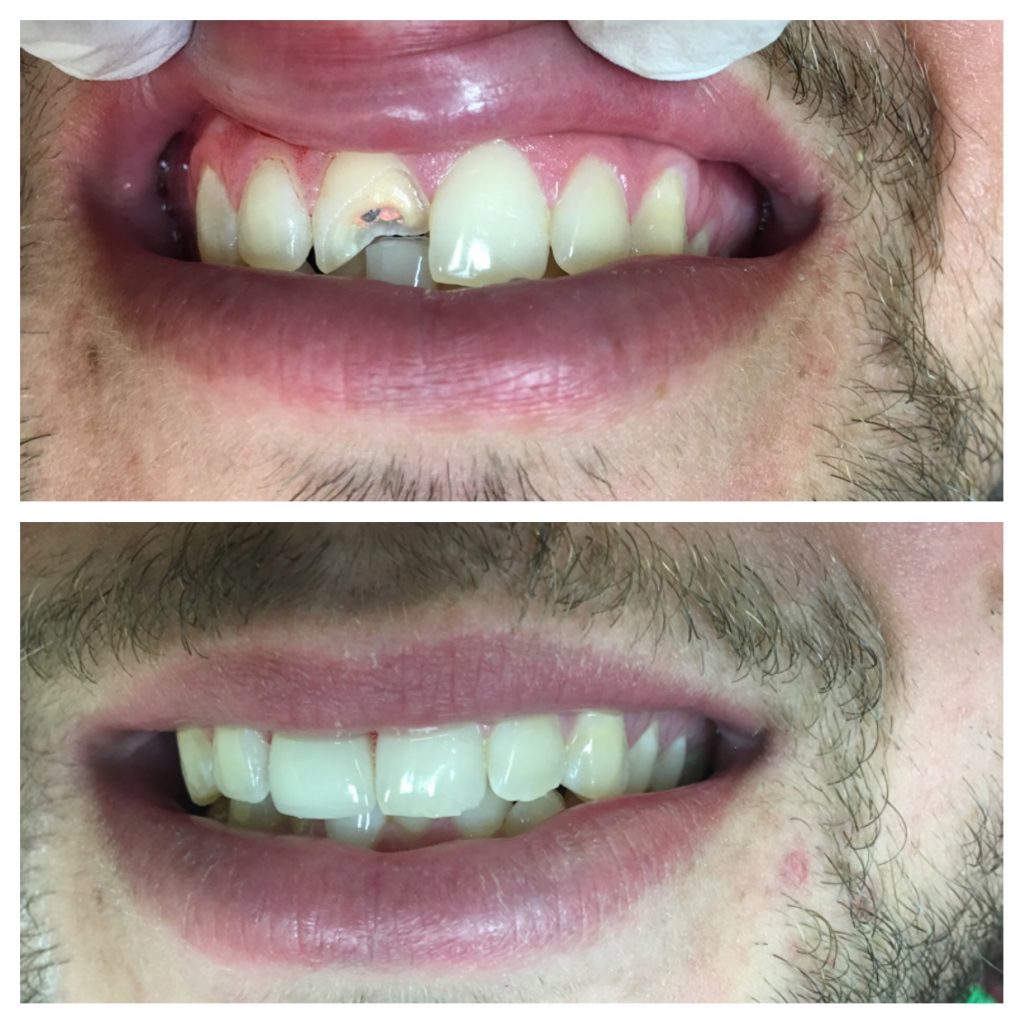 Broken Front Tooth Before And After