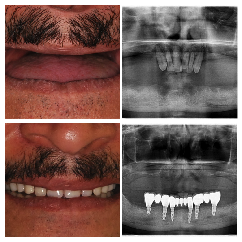 Fixed Implant Supported Teeth 01