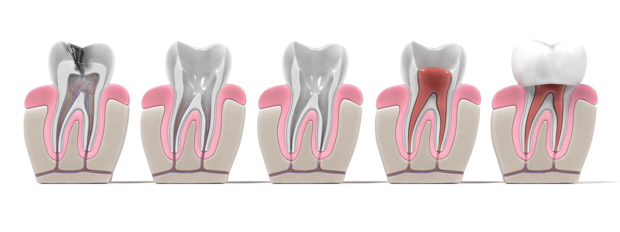 3d Renderings Of Endodontics Root Canal Procedure