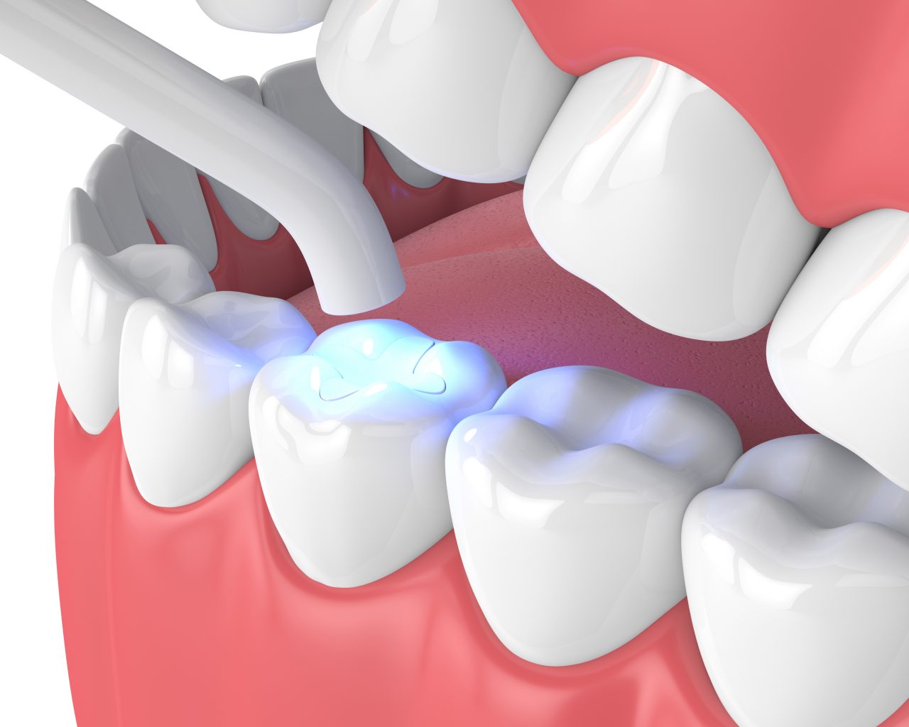 3d Render Of Jaw With Dental Polymerization Lamp And Light Cured Inlay