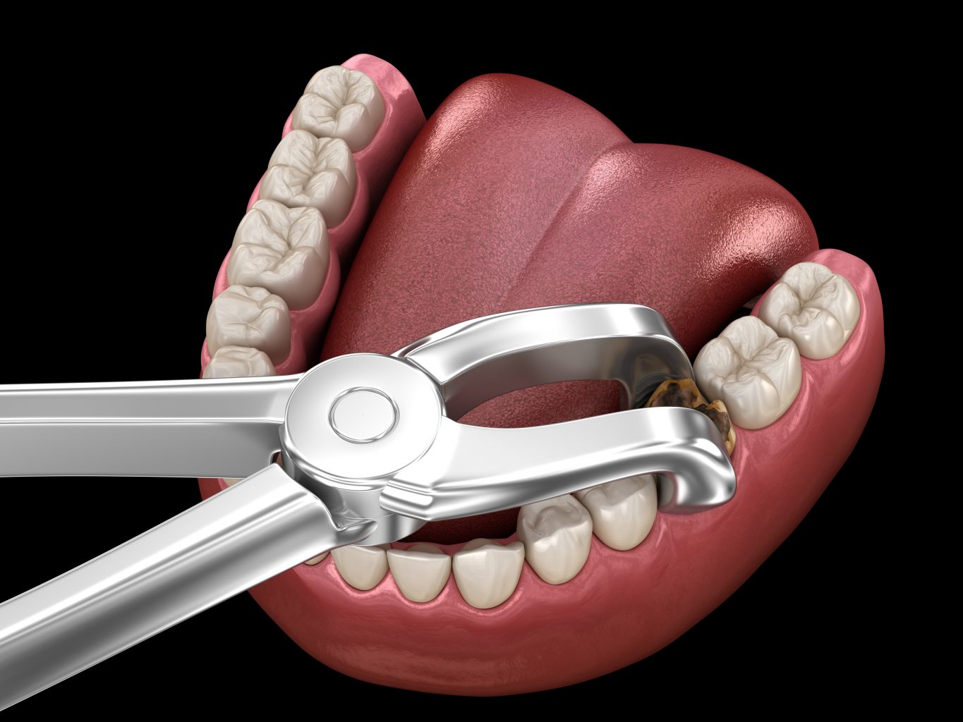 Extraction Of Molar Tooth Damaged By Caries. Medically Accurate Tooth 3d Illustration.
