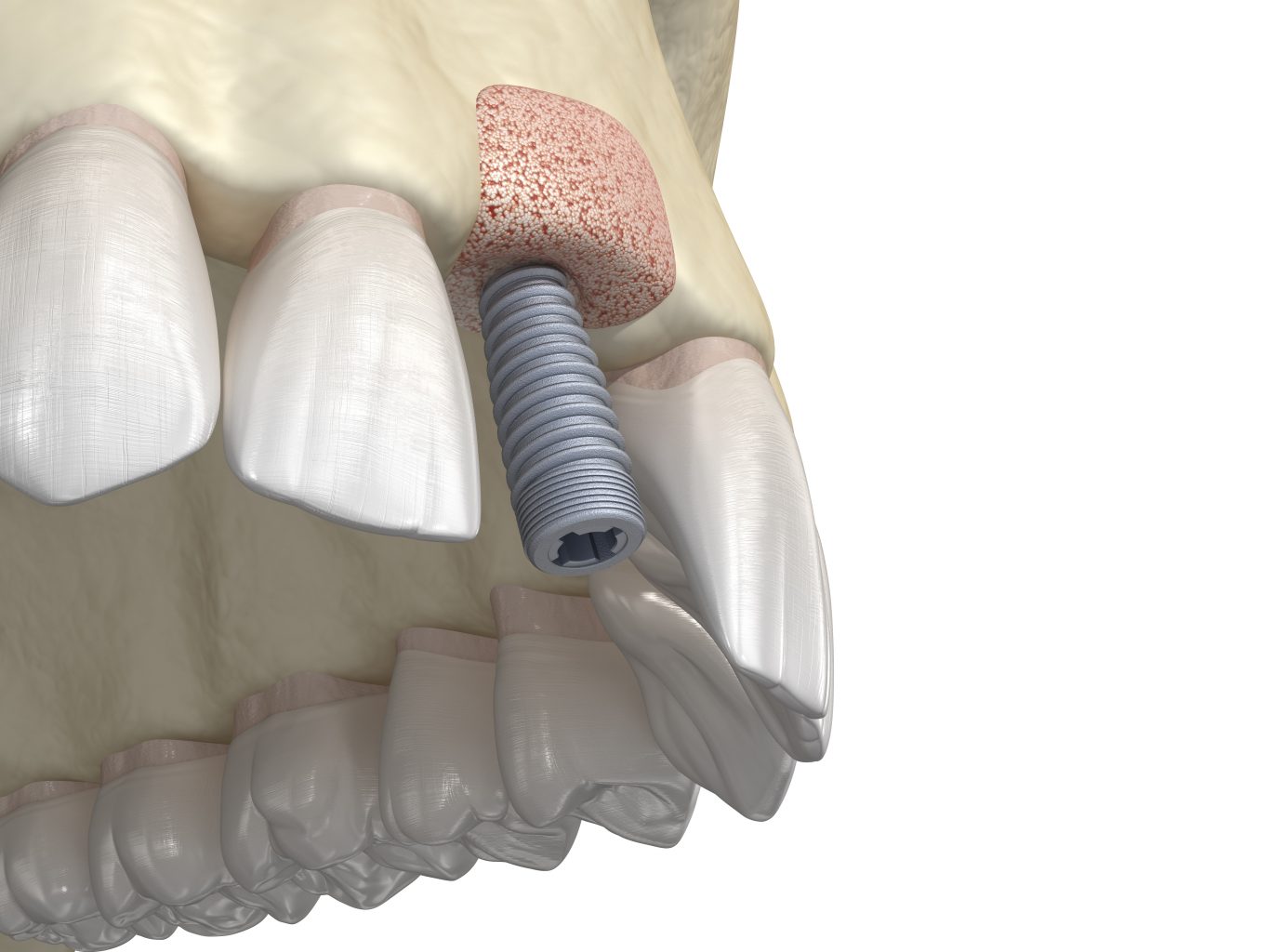 Bone Grafting Augmentation Using Ring Method, Tooth Implantation. Medically Accurate 3d Illustration